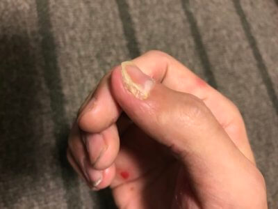 汗疱にビオチン治療してみる２ヶ月目の爪の変化横からの写真